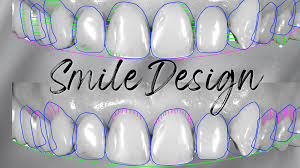 Hollywood Smile
