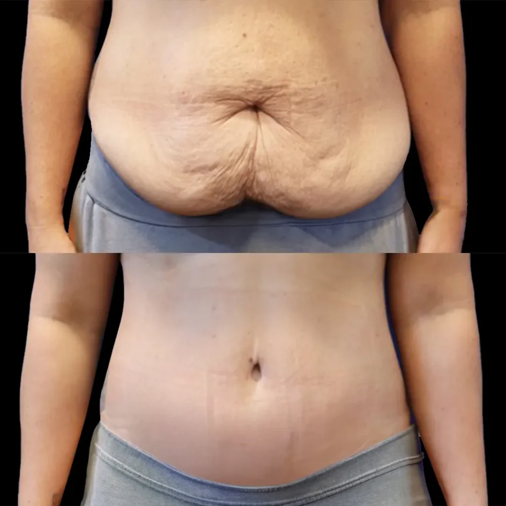 Tummy Tuck in Dubai