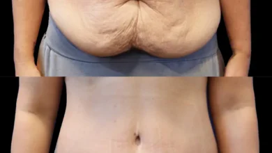 Tummy Tuck in Dubai